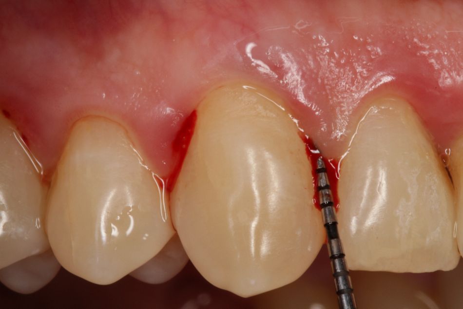 Fig. 2. Periodontal pocket, pocket probe depth 8 mm, BOP+.