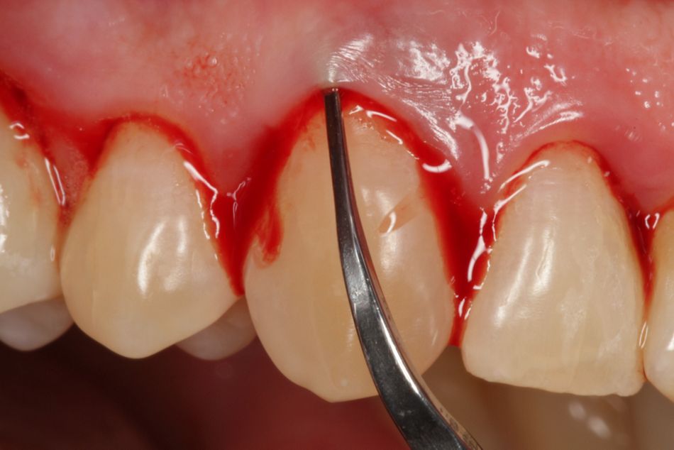 Fig. 3. After anesthesia, the surface of the root is mechanically debrided...