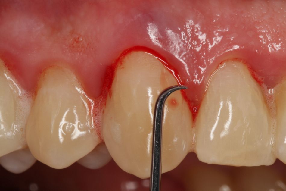 Fig. 5. ...and with microcurrettes. The surface of the root should ideally be clean so that Straumann® Emdogain® FL can achieve its full effect. Magnification aids (microscope or magnifying loupes) for a more precise view.