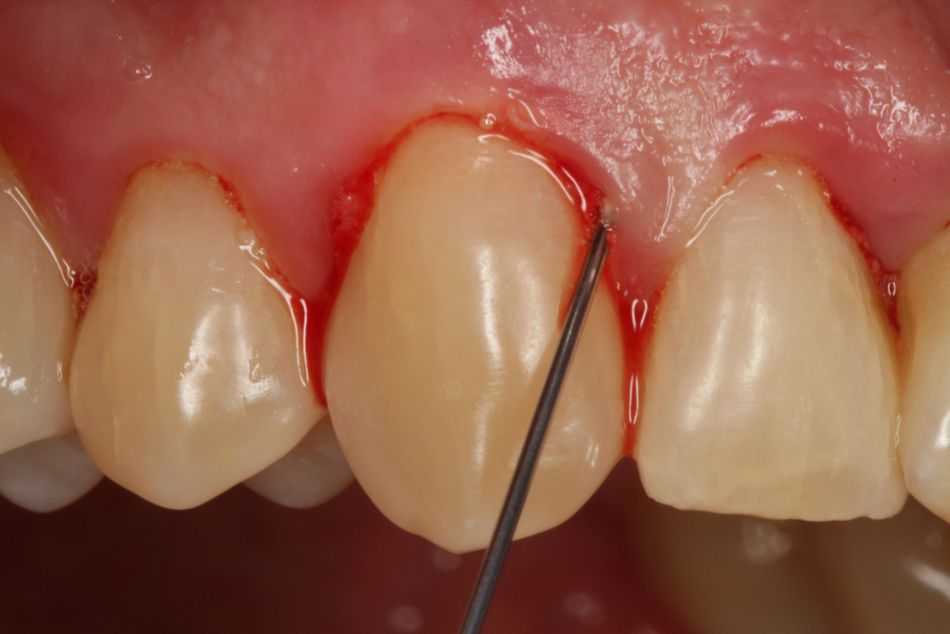 Fig. 6. Rinse with a sterile saline solution.