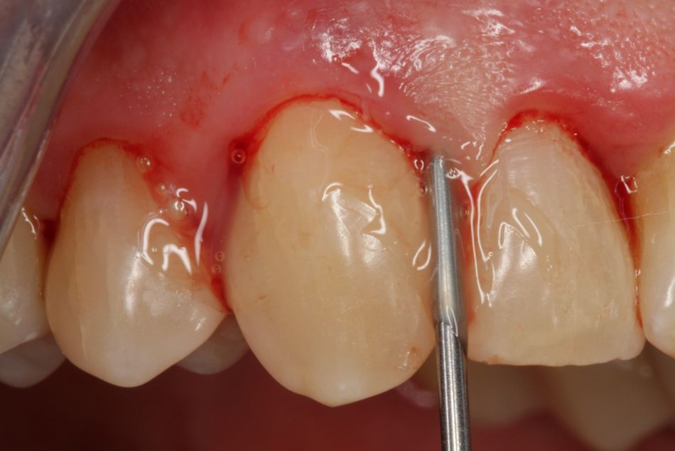 Fig. 8. The special tip allows Straumann® Emdogain® FL to be more easily applied. After this, the gingival margin is carefully adapted against the tooth until the gum surrounds the tooth.