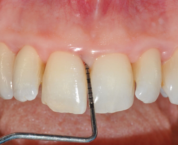 Fig. 1: Initial clinical situation with a periodontal pocket/intrabony defect between the upper central incisors at the mesial aspect of the 11 displaying a probing depth of 7 mm and bleeding on probing.