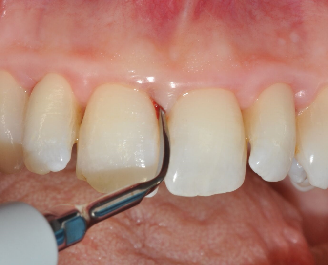 Fig. 2: Root instrumentation (debridement and scaling).