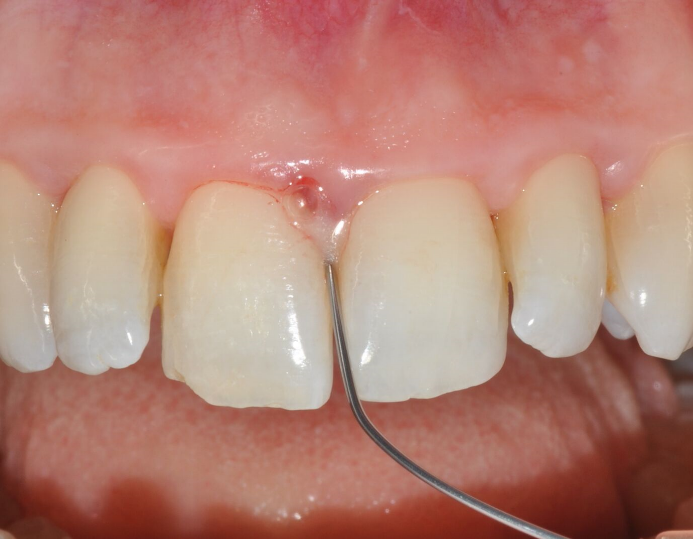 Fig. 3: PrefGel® used for root conditioning, left in situ for 2 minutes.