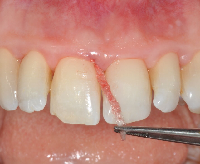 Fig. 5 Hemostasis / Control of bleeding: floss was applied in bleeding pockets and left in place for about 1 minute until adequate low levels of bleeding were achieved.