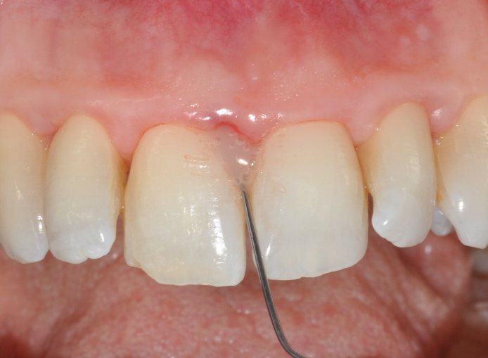Fig. 6: Emdogain® FL application, starting from the very bottom of the pocket until excess Emdogain® FL expelled from the pocket margin.
