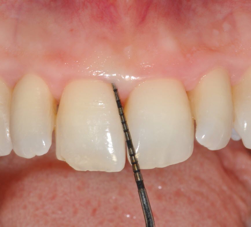 Fig. 7: Follow-up: 3 months after the treatment, the periodontal probing indicates a “solved” case with a probing depth of 3 mm.