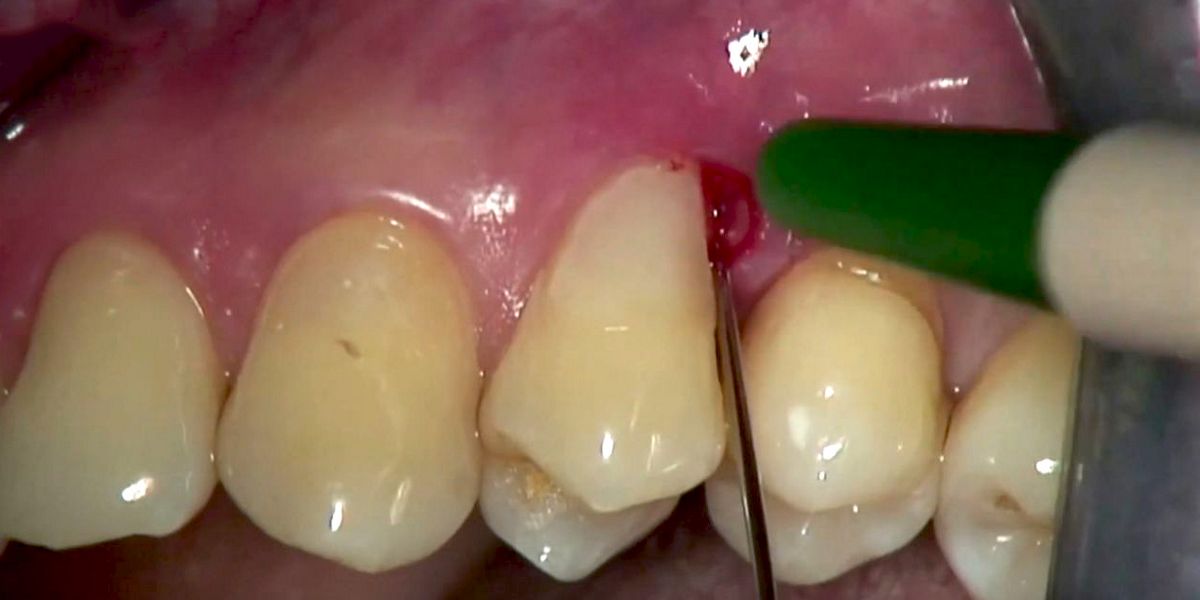 Prof Adrian Kasaj Non Surgical Application Of Straumann Emdogain Fl In A Residual Periodontal Pocket Of 8 Mm