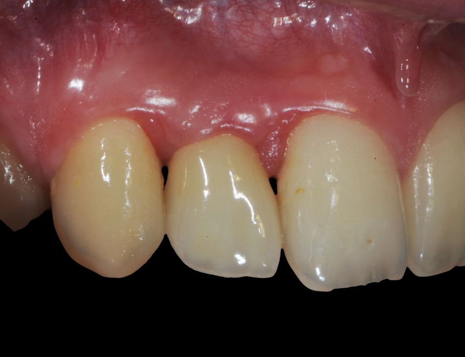 Figs. 5a/b: Clinical and radiological examination 1-year post-op, where an interdental augmentation of the papilla could be observed.