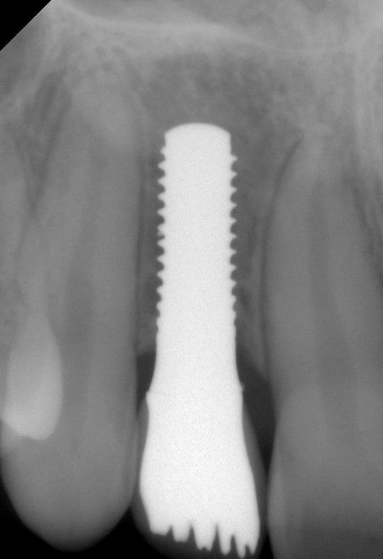 Figs. 5a/b: Clinical and radiological examination 1-year post-op, where an interdental augmentation of the papilla could be observed.