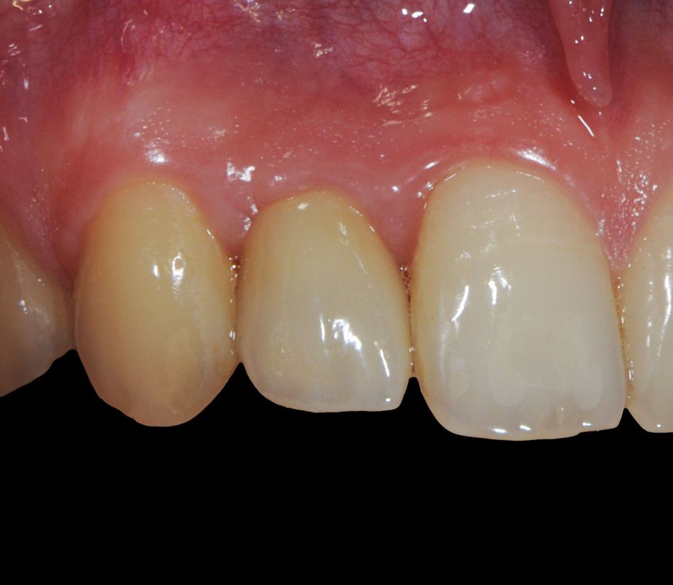 Fig. 6:  The 4-years follow-up showed an ideal red-white esthetics with full papilla formation.