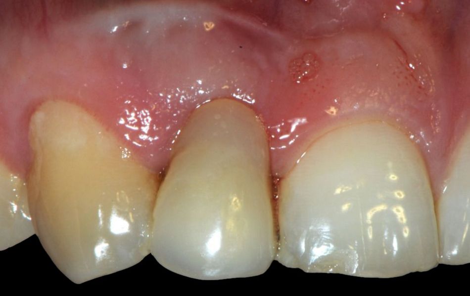 Fig. 1a: Due to a vertical root fracture, tooth 12 was no longer worth saving.  (All figures: Dr. Kristian Kniha, Aachen)