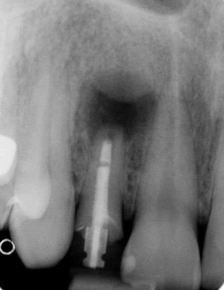 Fig. 1b: Radiologically, tooth 12 also showed chronic apical periodontitis. 