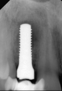 Fig. 2: In this case, a two-stage procedure was adopted. Three months after atraumatic extraction of tooth 12, a two-piece zirconia implant (from Straumann) was implanted. The radiological follow-up was prepared directly after implantation.