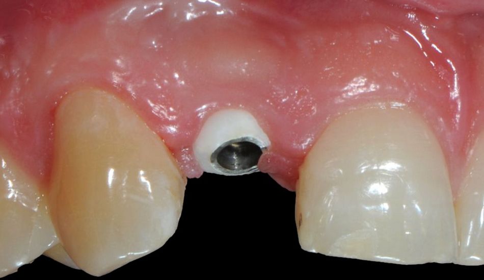 Figs. 3a and b: A customized ceramic healing abutment was used during the operation. The clinical situation after a three-month healing phase shows positive soft tissue conditioning.