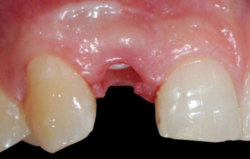 Figs. 3a and b: A customized ceramic healing abutment was used during the operation. The clinical situation after a three-month healing phase shows positive soft tissue conditioning.