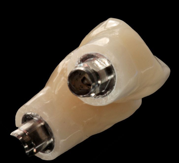Fig. 4a: The definitive implant-retained prosthetic restoration was based on a screw-retained zirconia framework.