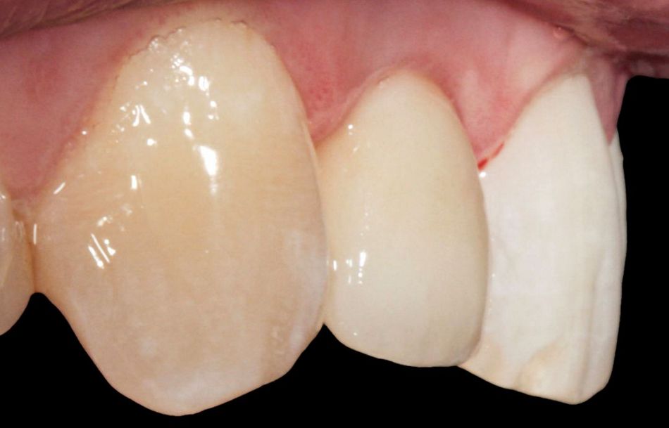 Fig. 5: Clinical situation with the final crown in region 12. In this case, the insertion was carried out using a reversible screw connection.