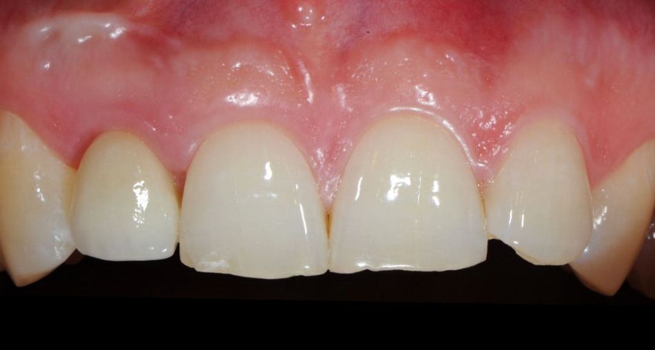 Fig. 6: Follow-up one year after insertion of the final crown. There is an increase in the interdental papillae in region 12.