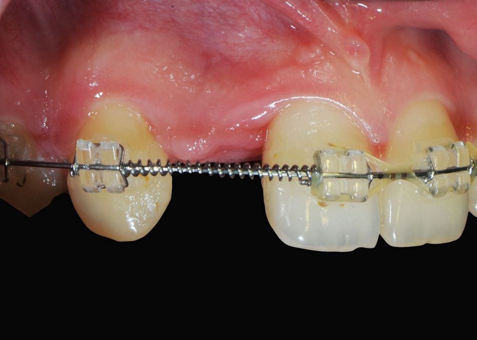 Fig. 1: The initial situation displayed a congenitally missing tooth in regio 12 with an orthodontic gap opening.