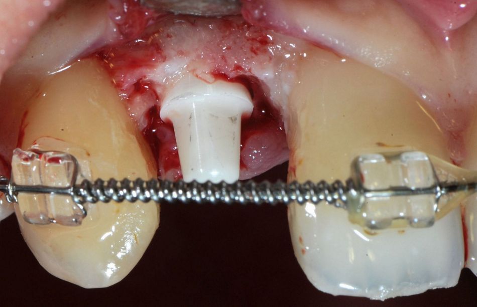 Fig. 2: Implant insertion of a one-piece ceramic implant in regio 12.