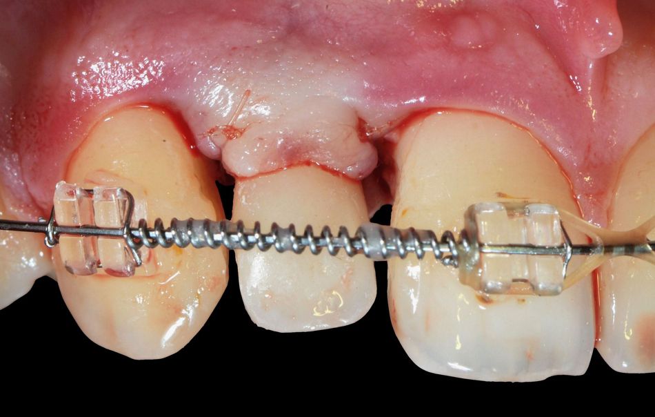 Figs. 3a/b: Immediate restoration without immediate loading and a chair-side provisional (the crown was taken out of occlusion)