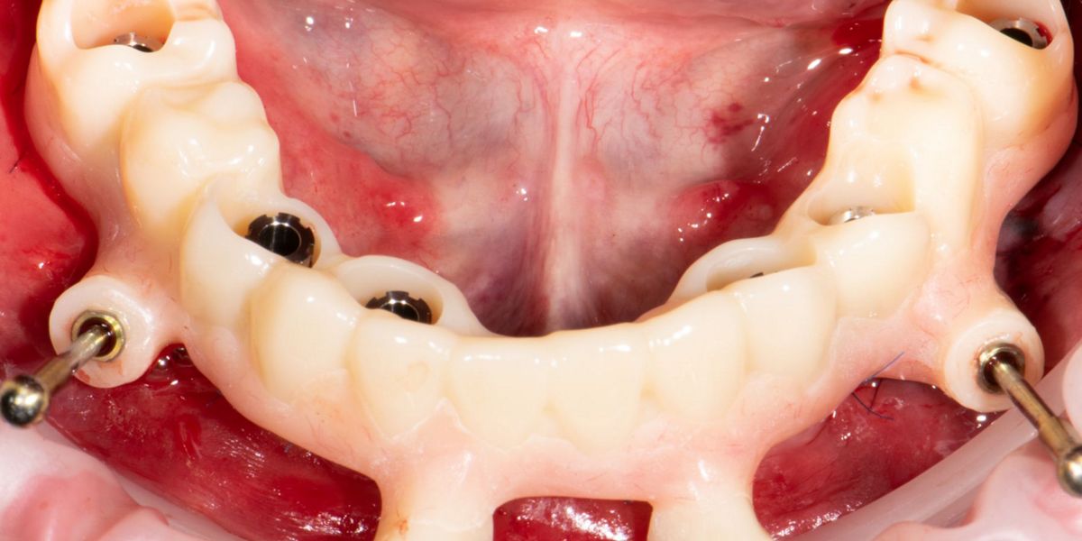 Computerassisted implant placement and fullarch immediate loading with digitally prefabricated