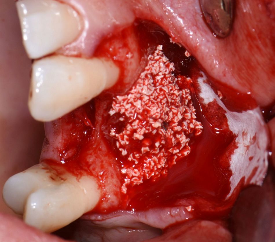Figure 10: Particulate bone substitute. A xenograft bone substitute was applied on top of the block graft.
