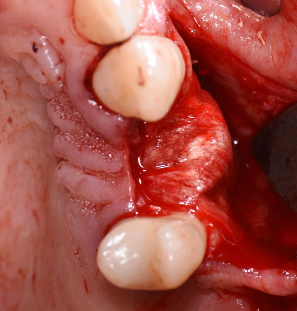 Figure 11: Membrane coverage. The grafting site was covered with a collagen membrane.
