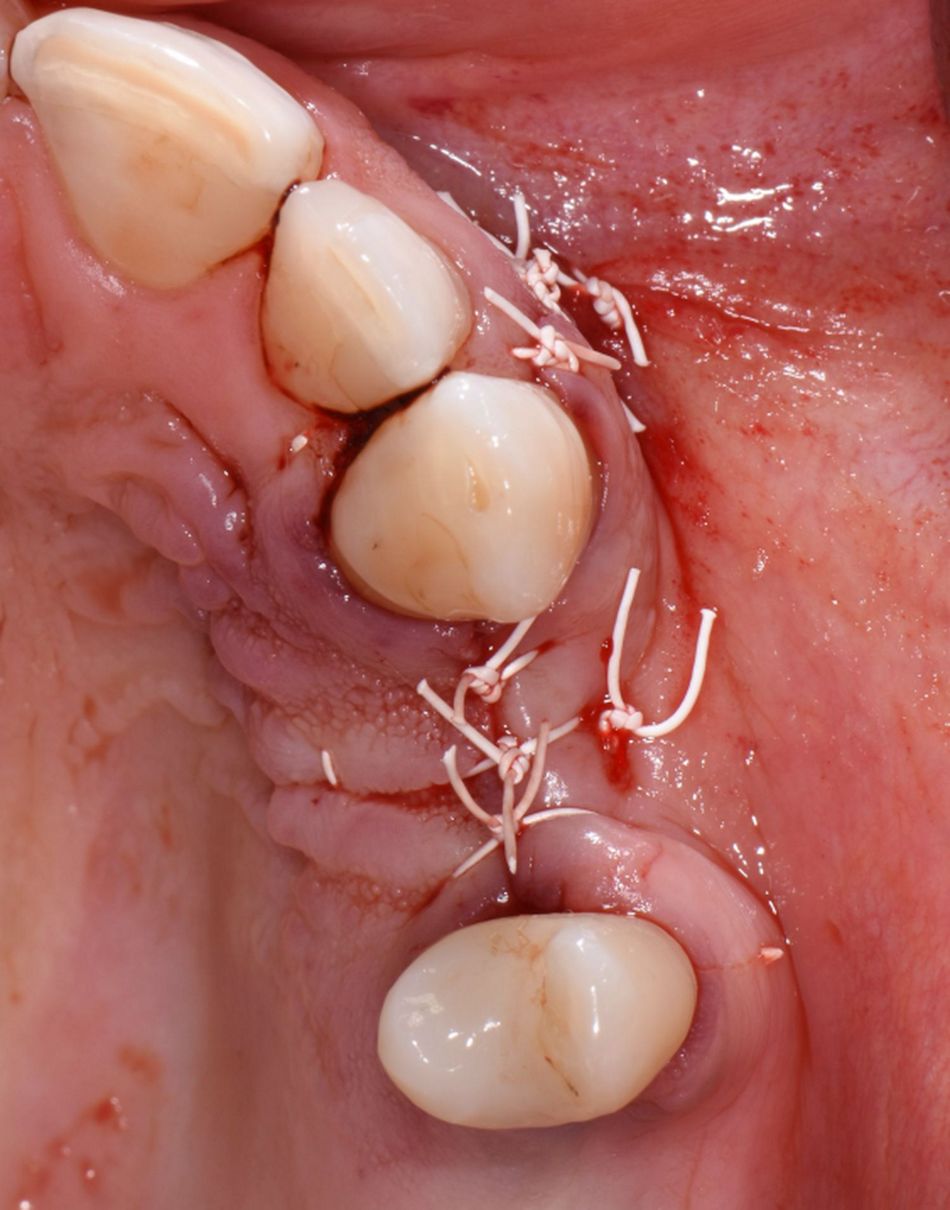Figure 12: Wound closure. After periosteum releasing incision, the flap was closed with ePTFE sutures.