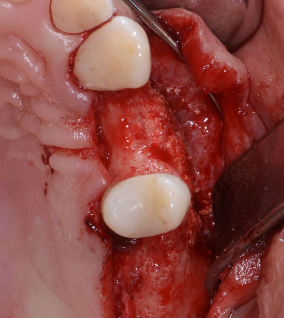 Figure 13: Flap elevation. After 9 months, a favorable bony situation could be seen.