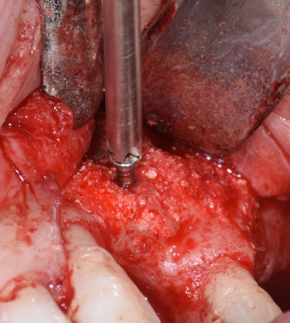 Figure 14: Screw removal. After uncovering, both osteosynthesis screws could be removed successfully.