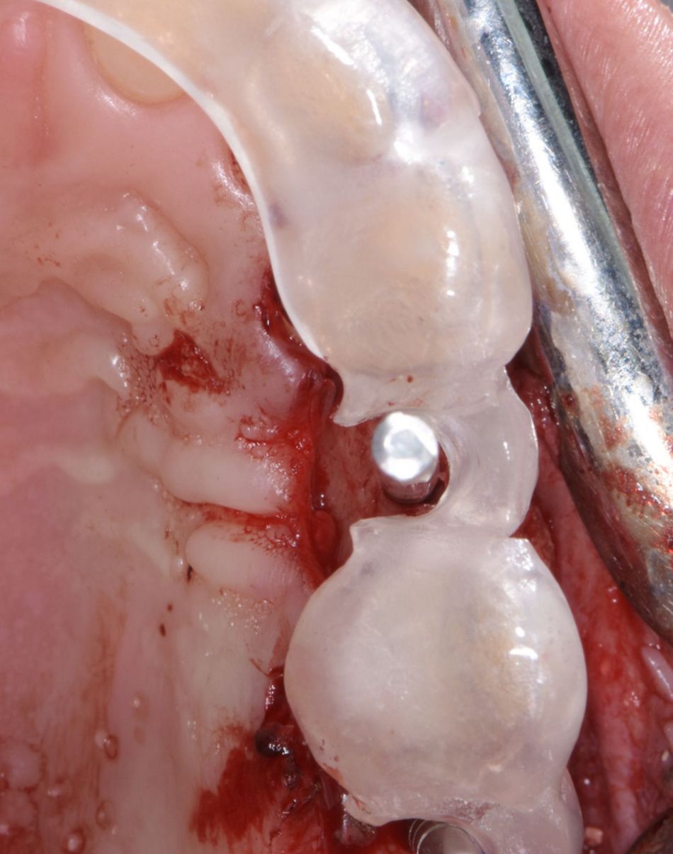 Figure 15 & Figure 16: Implant bed preparation. A surgical stent was used to ensure a correct 3D position of the implant.