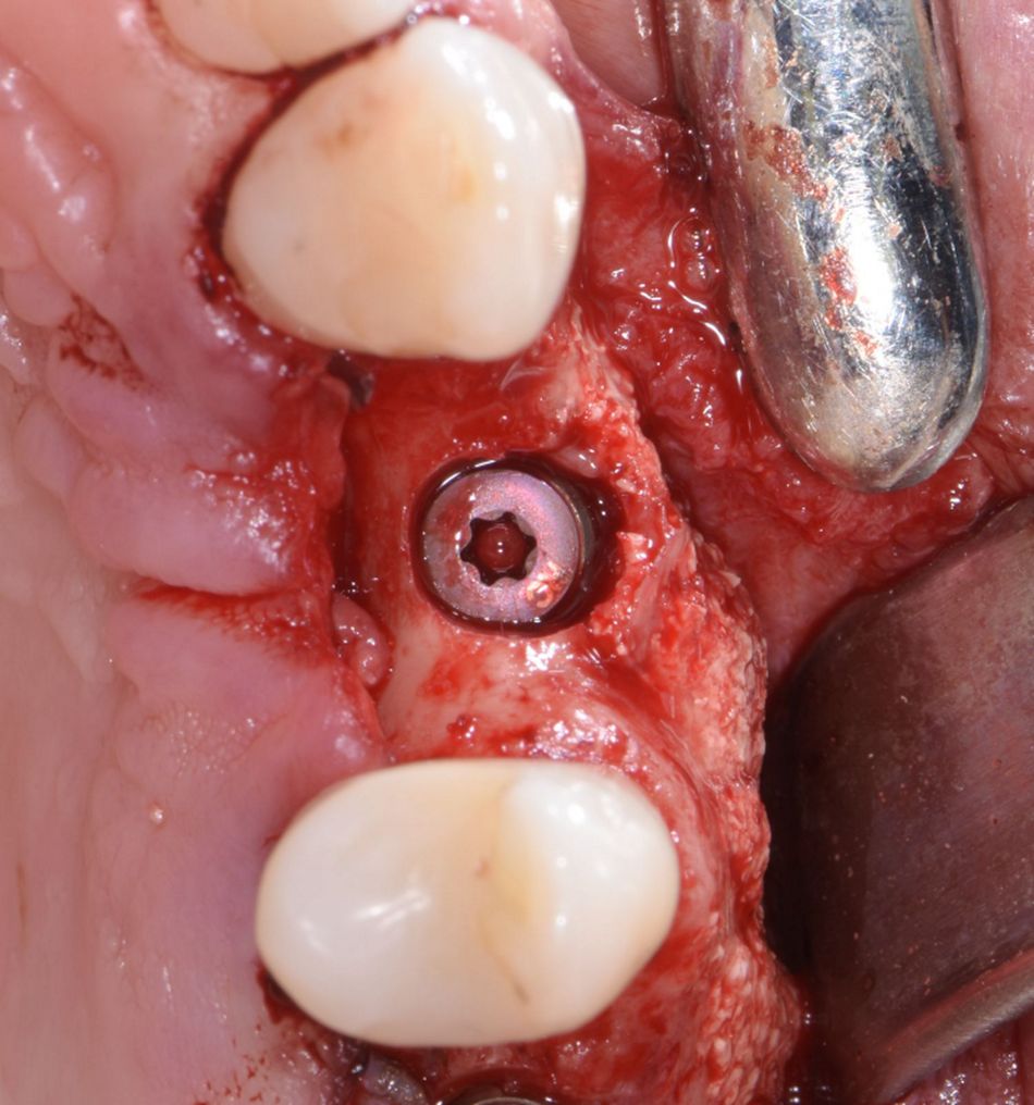 Figure 17: Implant placement. A bone-level type implant was installed with good primary stability.