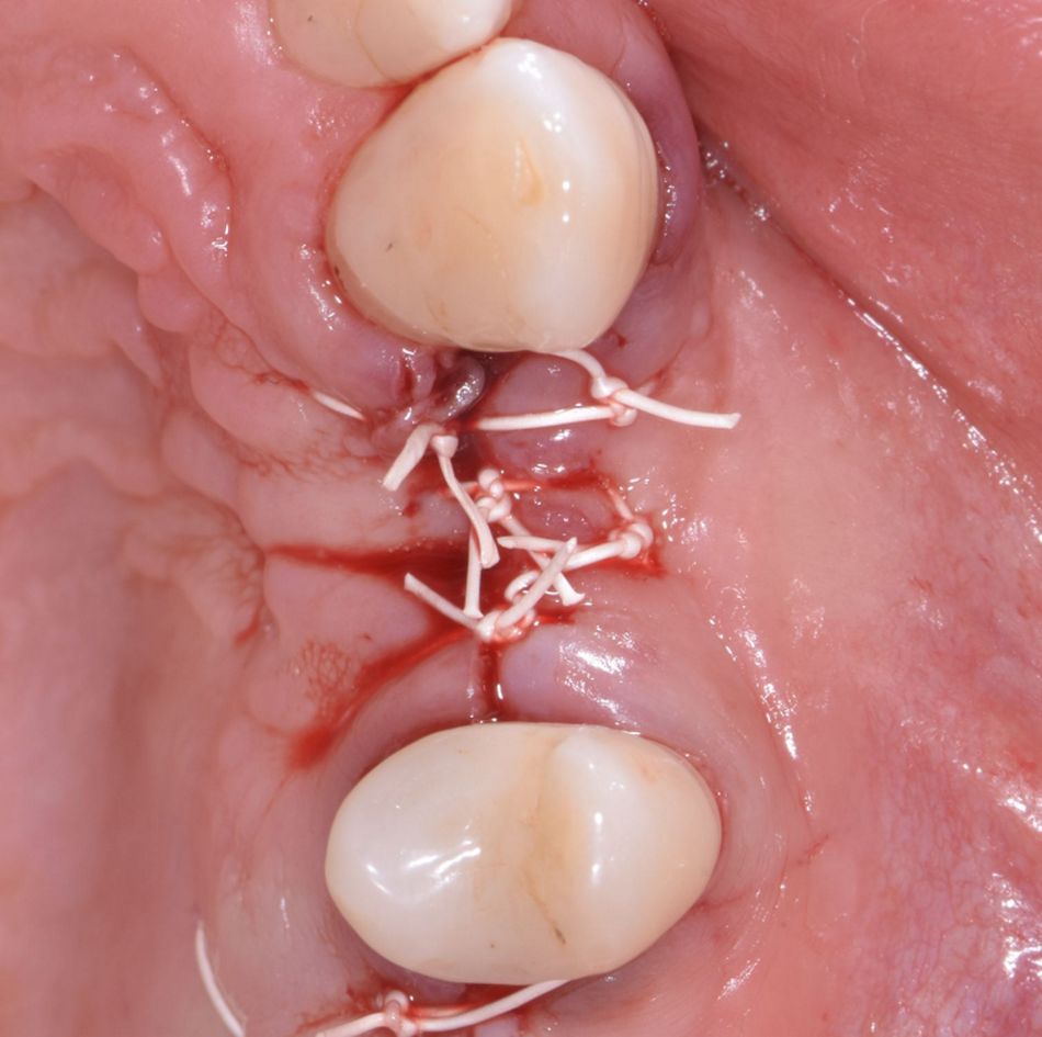 Figure 19: Wound closure. The flap could be closed without a periosteum releasing incision.