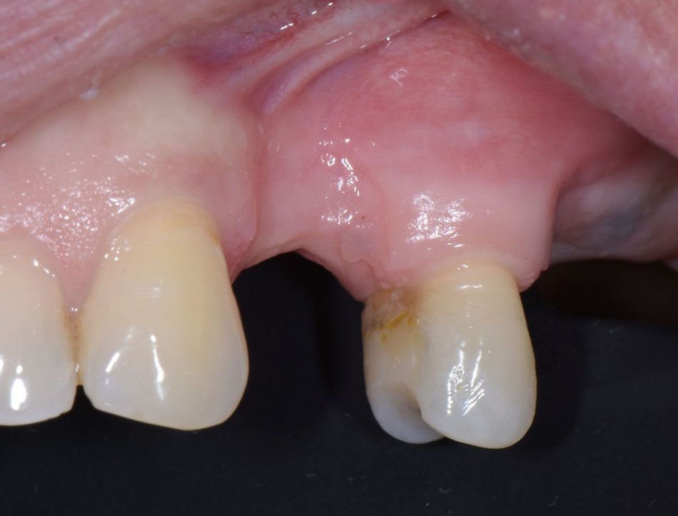 Figure 1 & Figure 2: Initial Situation. Lateral & occlusal view of the severe hard and soft tissue defect at site 24 with sufficient keratinized mucosa