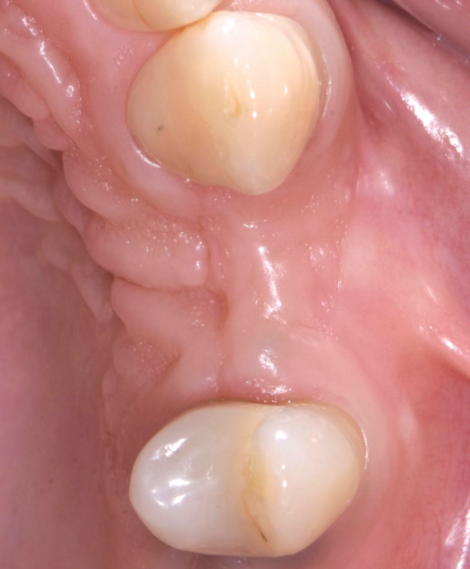 Figure 20: Soft tissue after healing. A reduced amount of soft tissue volume and keratinized mucosa height could be seen.