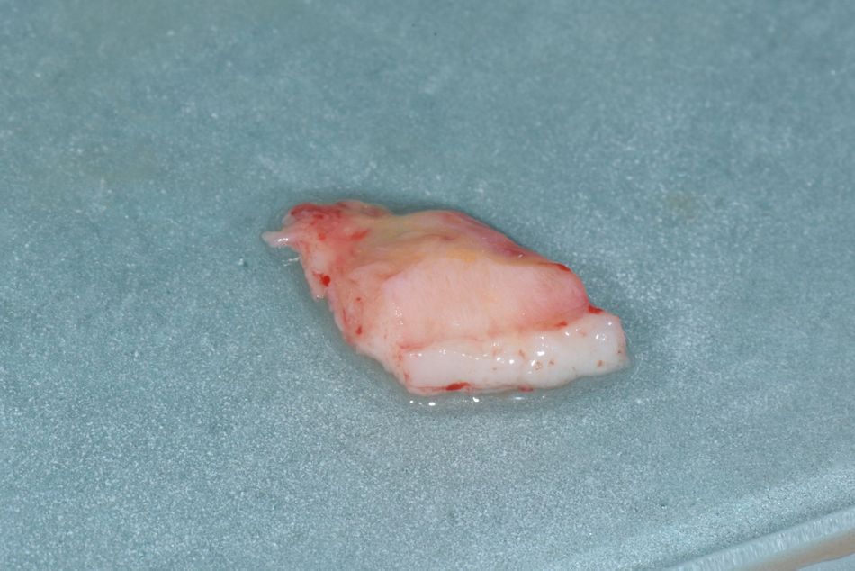Figure 22: Soft tissue graft. A combined connective and keratinized tissue graft was harvested from the palate.