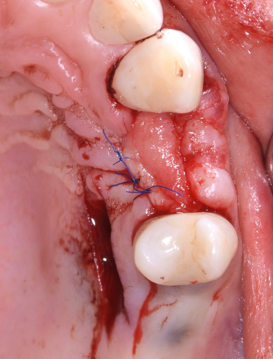 Figure 23: Graft in place. The connective tissue part of the graft was placed into the vestibular split-flap pouch, while the keratinized part was placed on the crest.