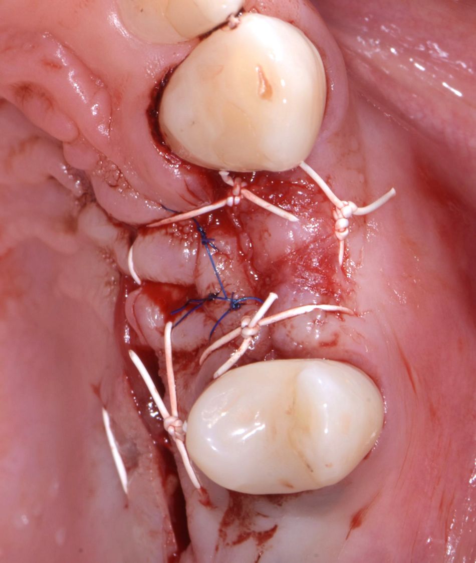 Figure 24: Wound closure. The flap and the donor site were closed with ePTFE sutures.