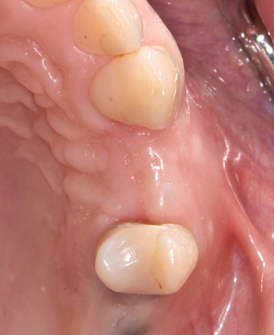 Figure 25: Status before reopening. Improved keratinized tissue height and adequate soft tissue volume could be detected.