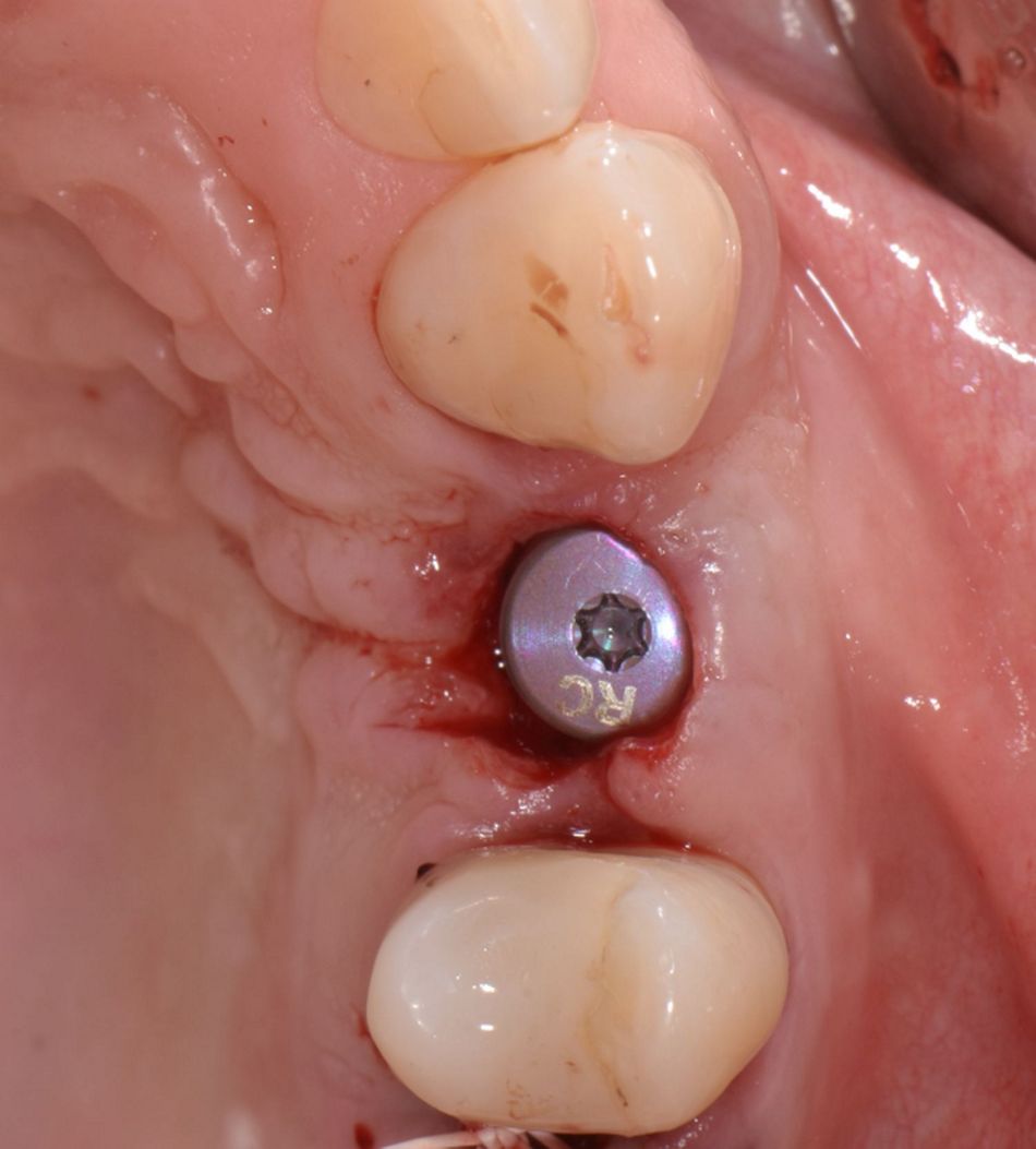 Figure 28: Mini-roll-flap technique. The mucosa was folded inwards towards the vestibular aspect.