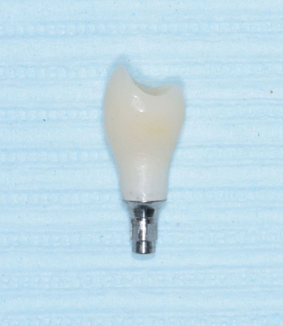 Figure 29: Temporary implant crown. A temporary crown was milled out of a PMMA acrylic resin block and luted onto a titanium resin base.