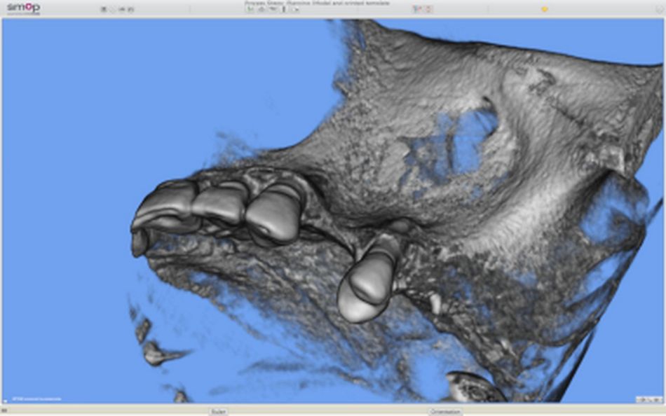 Figure 3: CBCT radiograph. The thin and high bone crest at site 24 impaired single-stage implant placement.