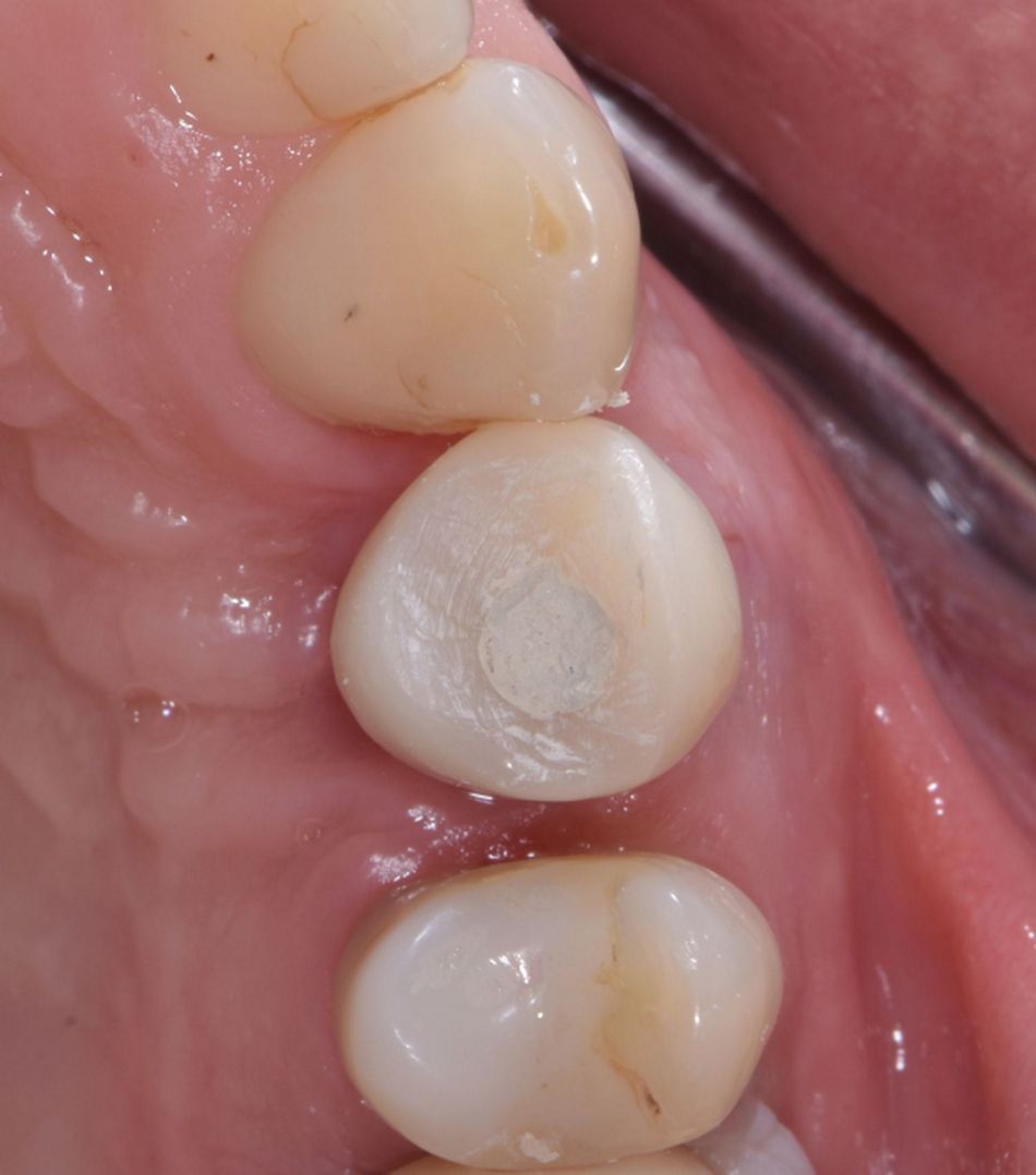 Figure 30 & Figure 31: Temporary crown in situ. Intraoral occlusal and lateral view of the temporary crown.