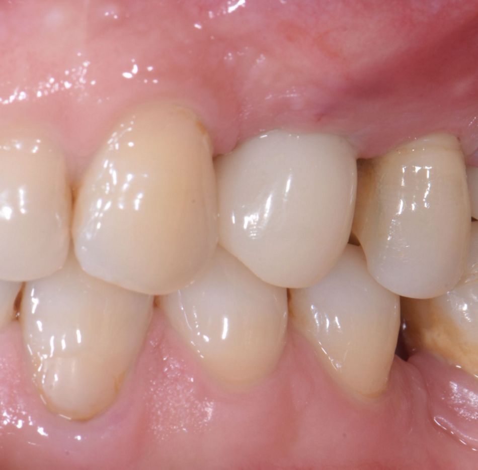 Figure 30 & Figure 31: Temporary crown in situ. Intraoral occlusal and lateral view of the temporary crown.