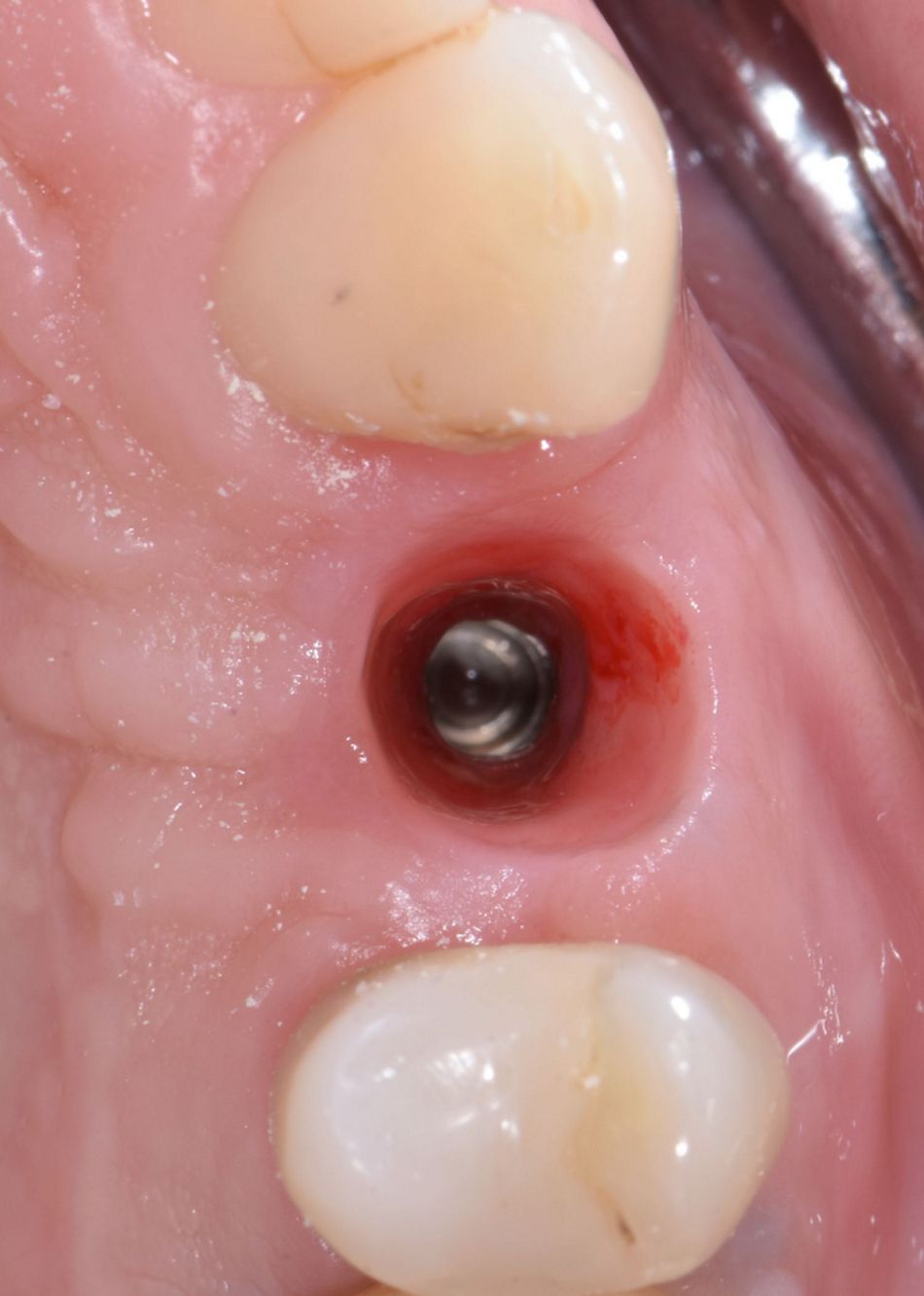 Figure 32 & Figure 33: Mucosa conditioning. By adding composite resin to the temporary crown, the peri-implant mucosa was conditioned to create an optimal emergence profile for the final restoration.