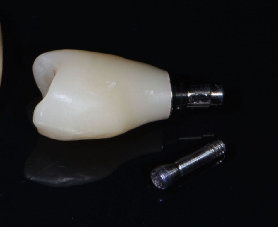 Figure 35: Framework stage. The final reconstruction was a monolithic glass-ceramic screw-retained crown cemented onto a titanium bonding base.