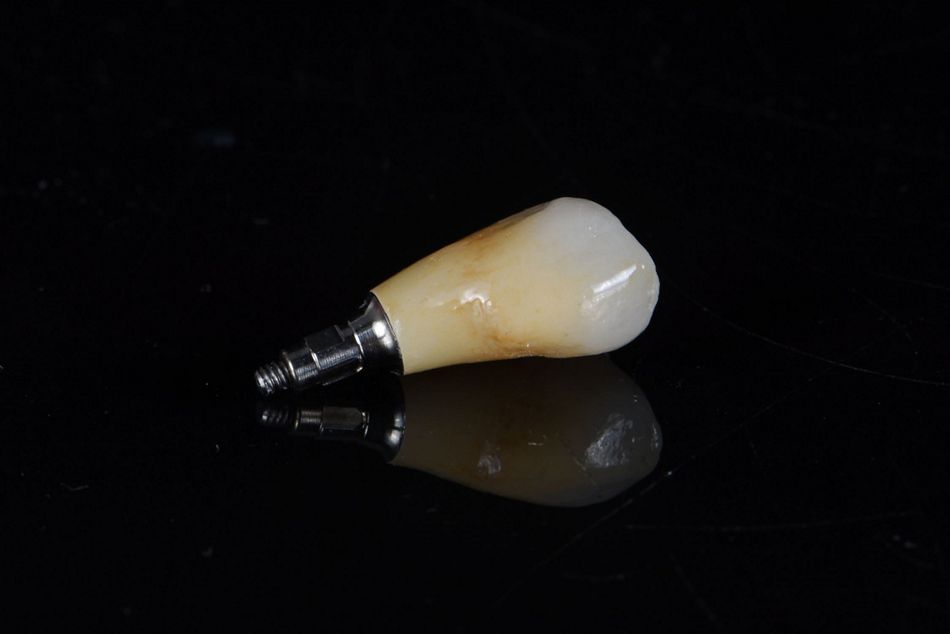 Figure 36: Bisque-stage. Individual staining by the laboratory technician for an optimal esthetic result.