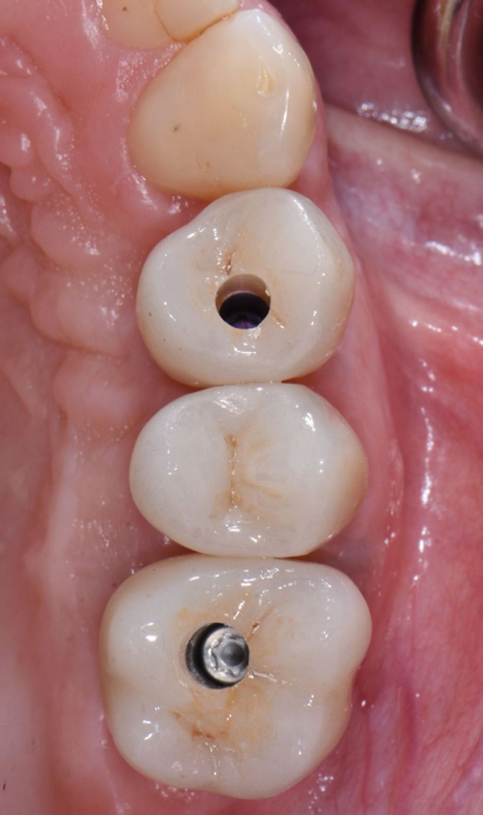 Figure 37: Final restoration in situ. The crown was tightened with 35Ncm and the access channel closed temporarily.